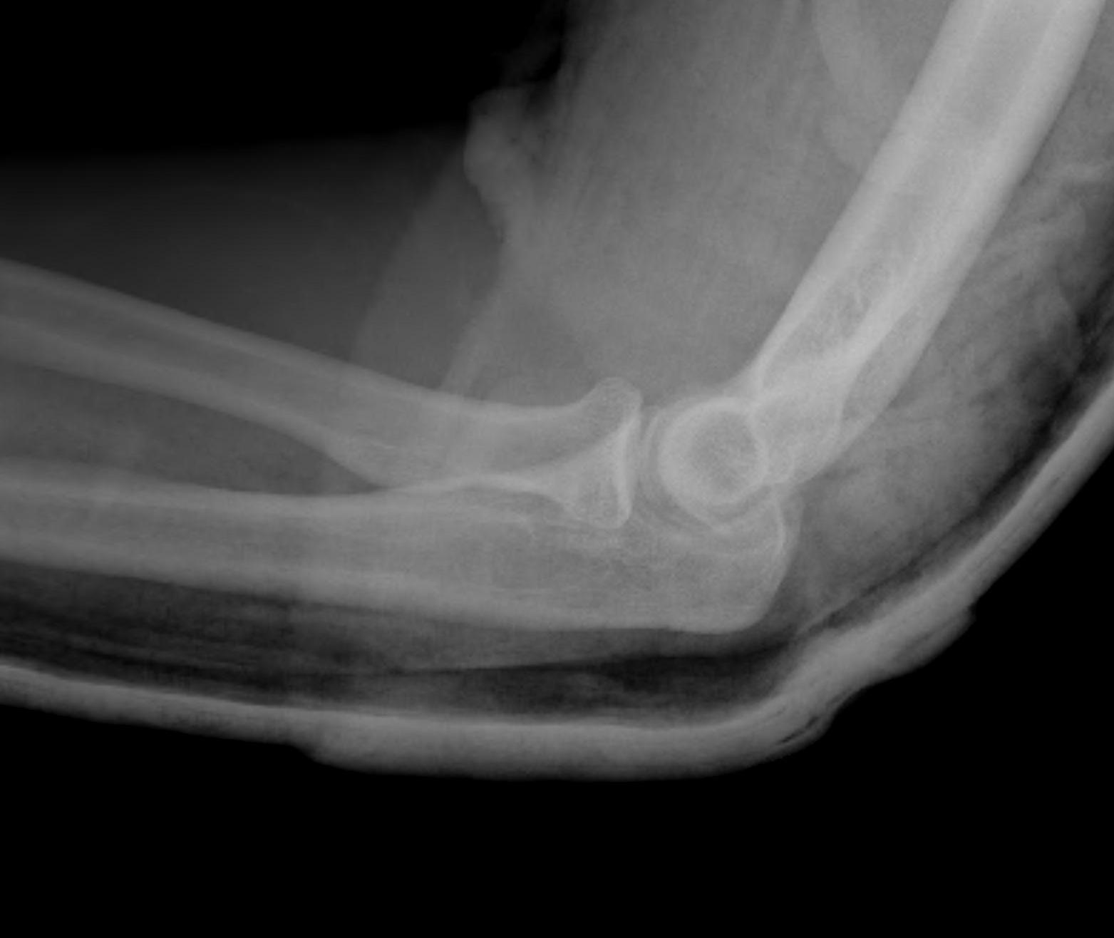 Elbow Simple Dislocation Reduced